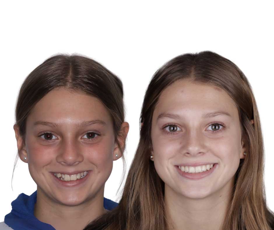 13 Portrait The left side of the image is a before photo of a child with crooked teeth and an uneven smile. On the right is an image of the same child with a straight even smile.