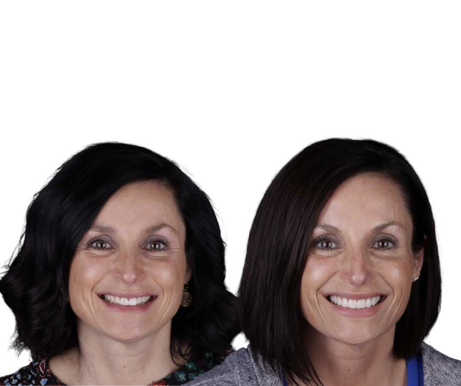 12 Portrait The left side of the image is a before photo of a woman in with a smile that is discolored. On the right is an image of the same woman with a bright white healthy smile.