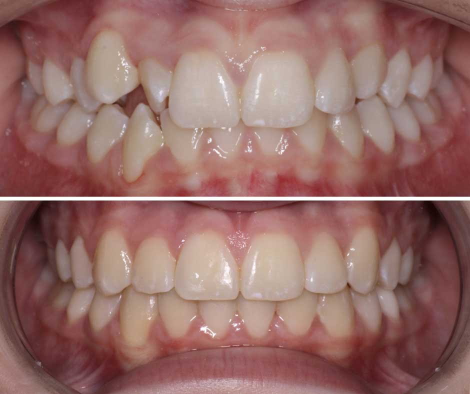 Smile 13 The top shows a before image of the inside of a mouth with uneven teeth. The bottom shows an after image of a straight set of teeth.