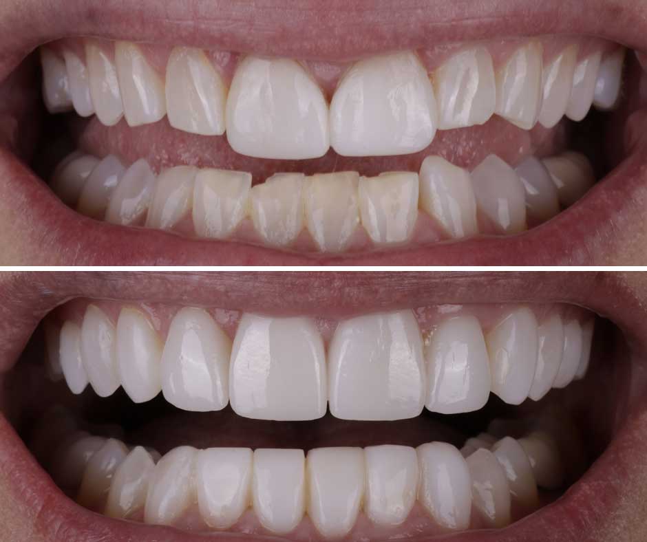 Smile 12 The top shows a before image of the inside of a mouth with uneven teeth and slight discoloration. The bottom shows an after image of a straight set of white teeth.