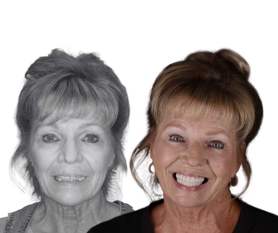 portrait-14 The left side of the image is a before photo of a woman in with a smile that has gaps and is misaligned. On the right is an image of the same woman with a bright white healthy smile.