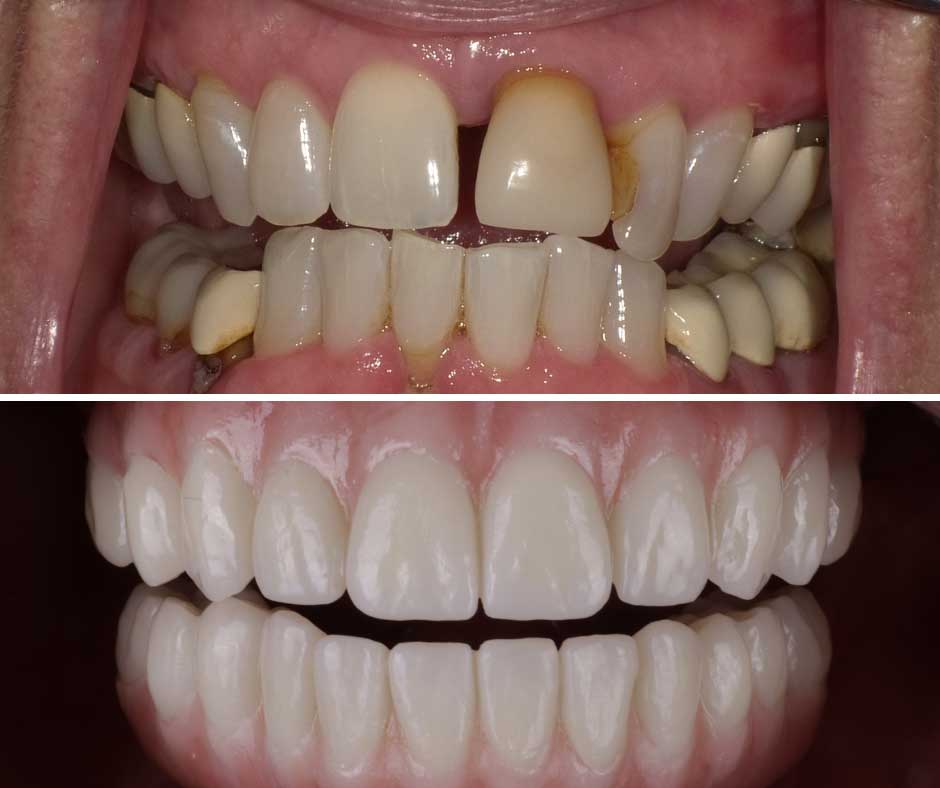 smile-14 The top shows a before image of the inside of a mouth with chipped and discolored teeth with plaque. The bottom shows an after image of a straight set of white teeth and healthy gums.